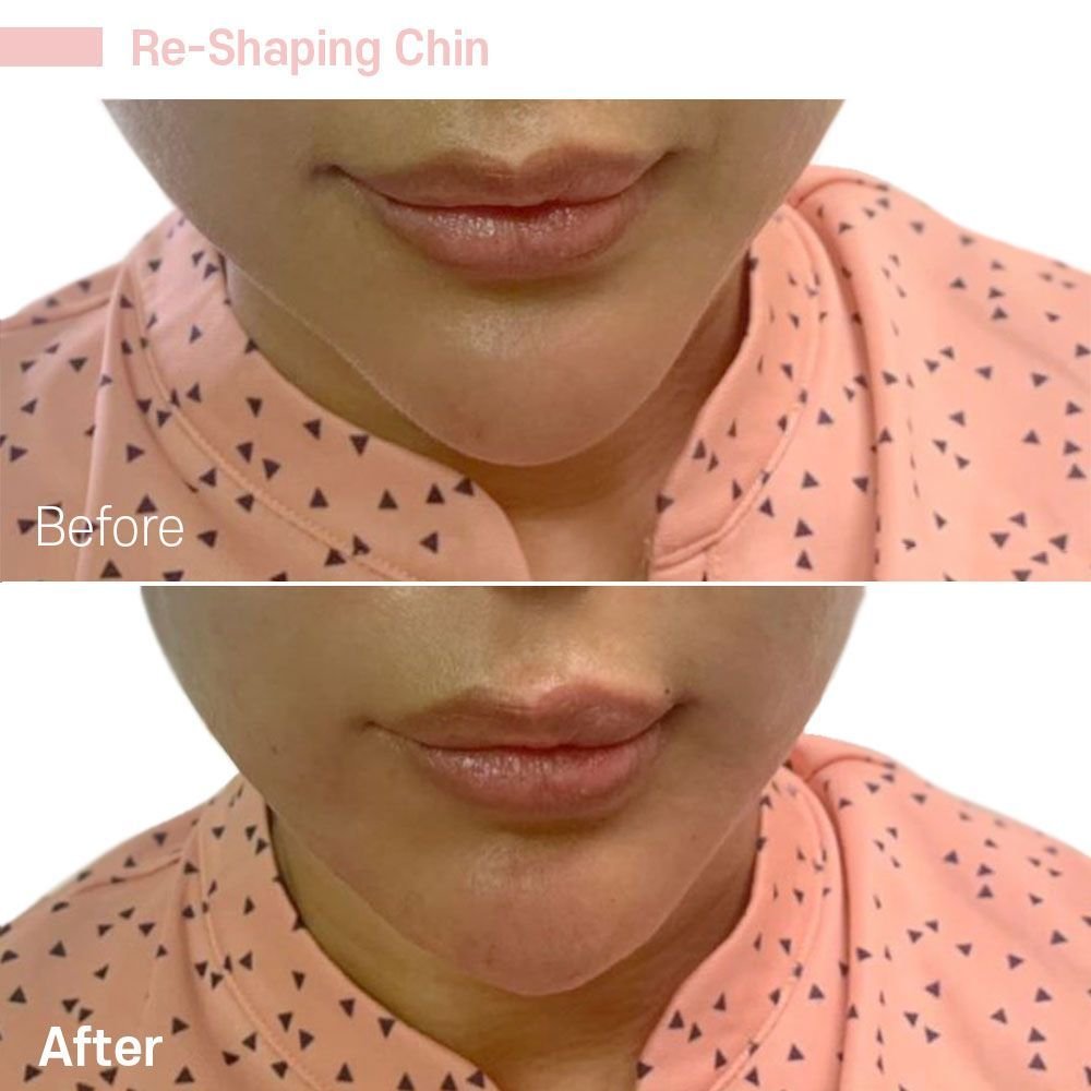 Chin 2 — before and after at nūri aesthetics
