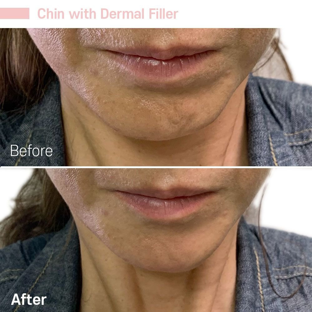Chin — before and after at nūri aesthetics