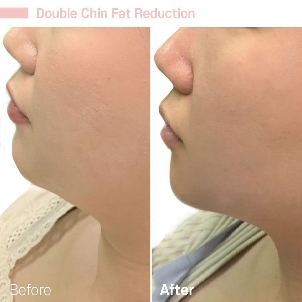 Double Chin Reduction — before and after at nūri aesthetics