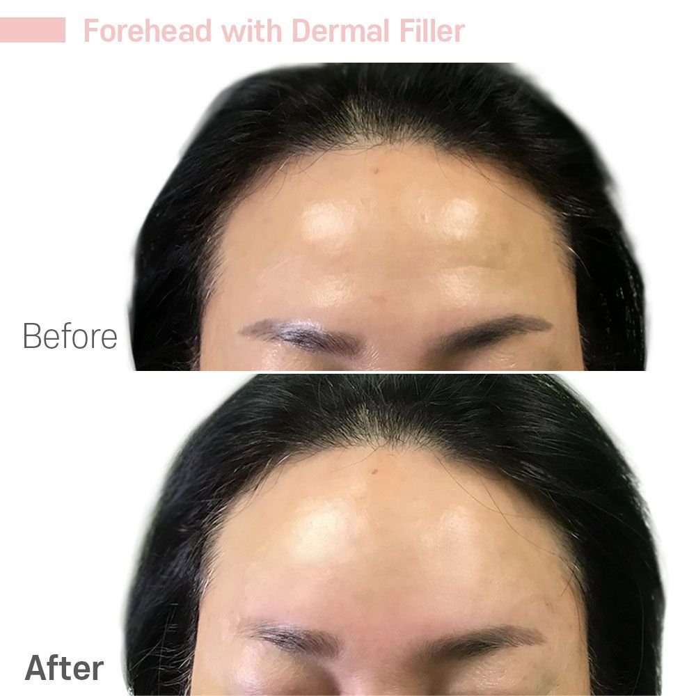 ForeHead 3 — before and after at nūri aesthetics
