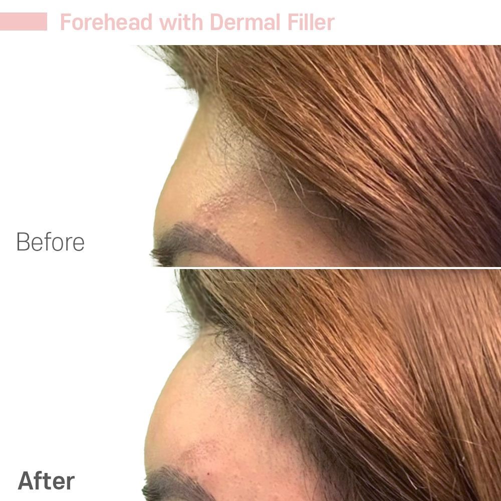 Forehead 7 — before and after at nūri aesthetics