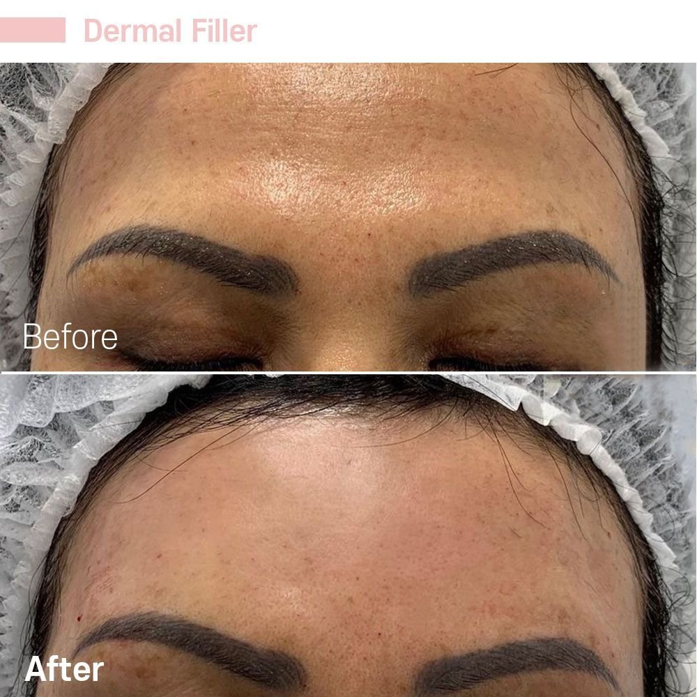Forehead 8 — before and after at nūri aesthetics