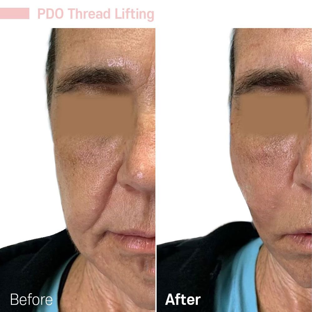 IMG_0600 — before and after at nūri aesthetics
