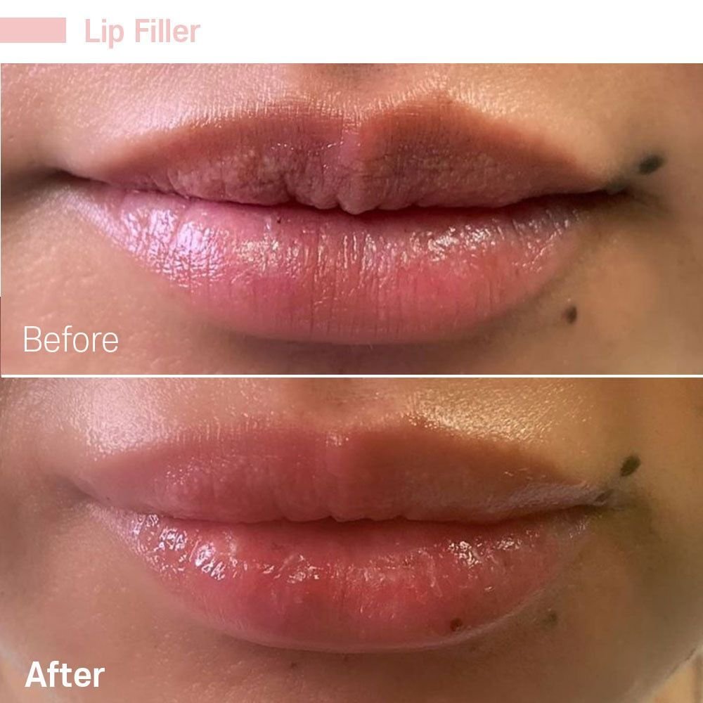 IMG_0604 — before and after at nūri aesthetics