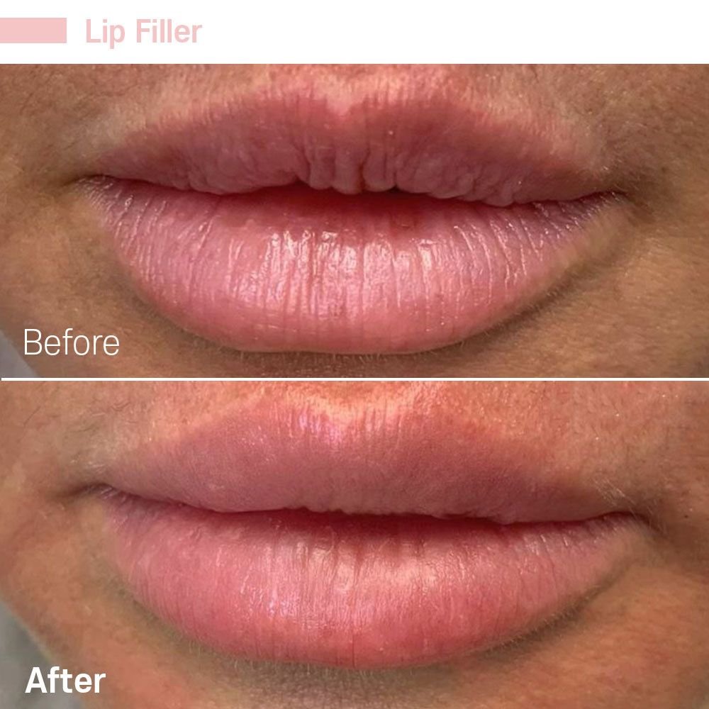 IMG_0609 — before and after at nūri aesthetics