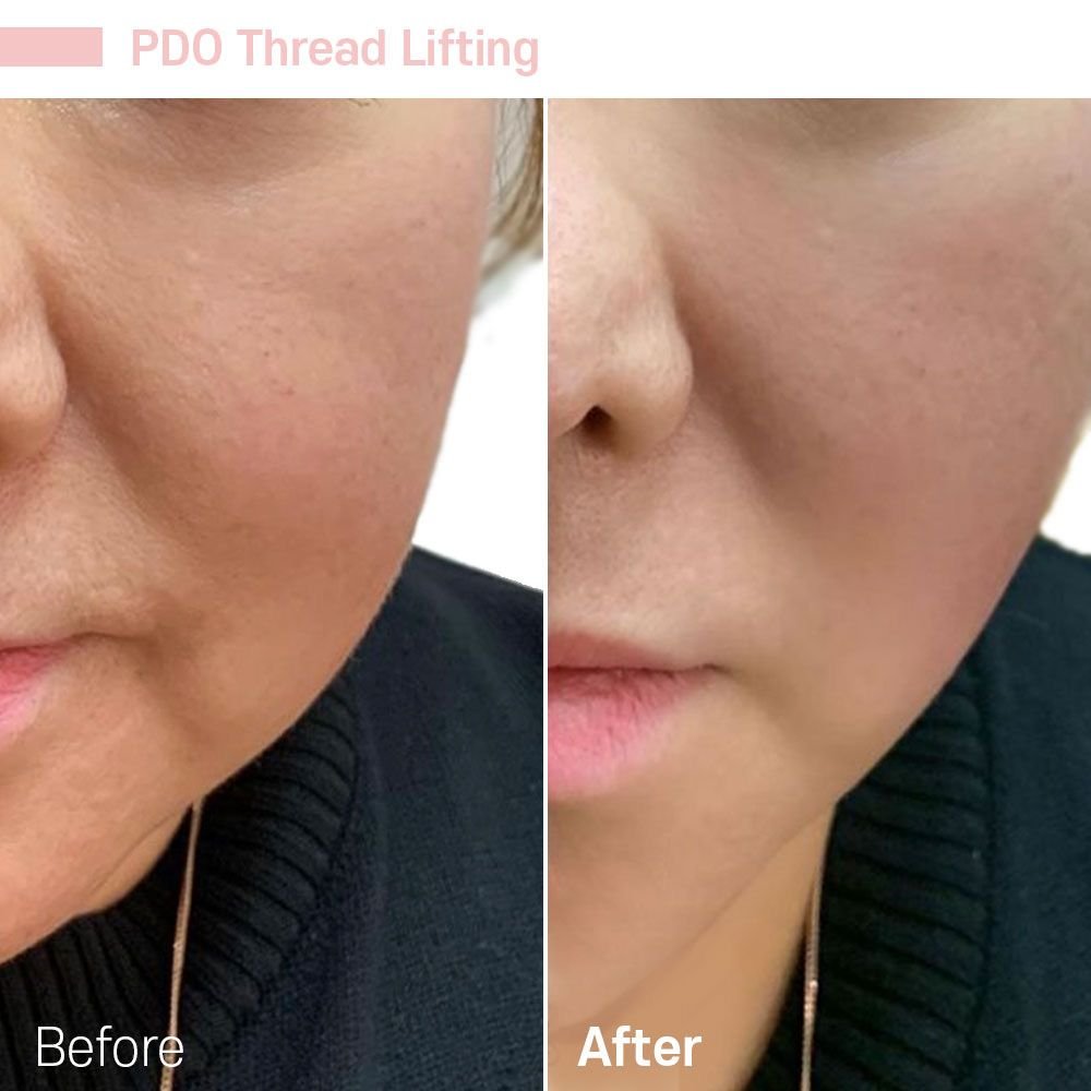 IMG_0612 — before and after at nūri aesthetics