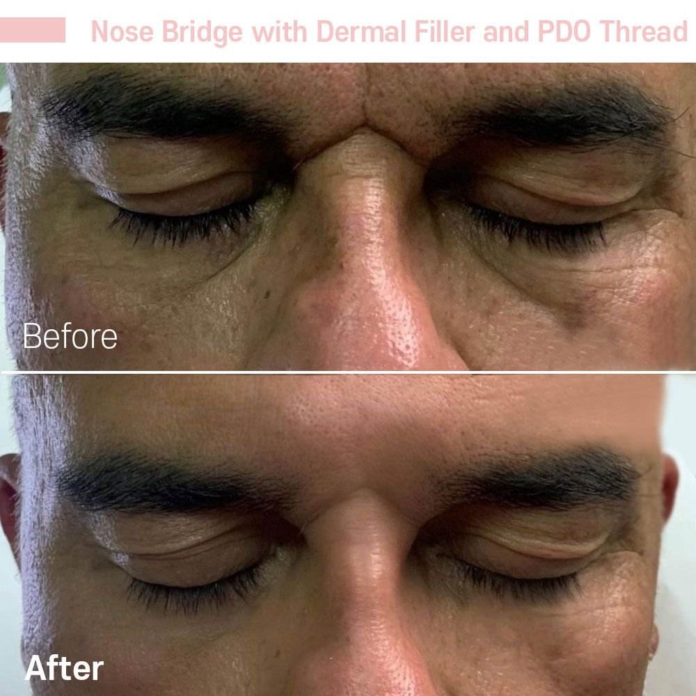 IMG_0619 — before and after at nūri aesthetics