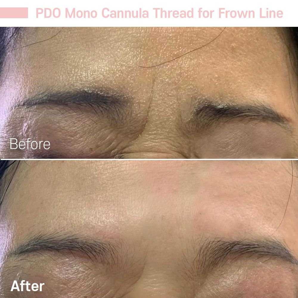 IMG_0621 — before and after at nūri aesthetics
