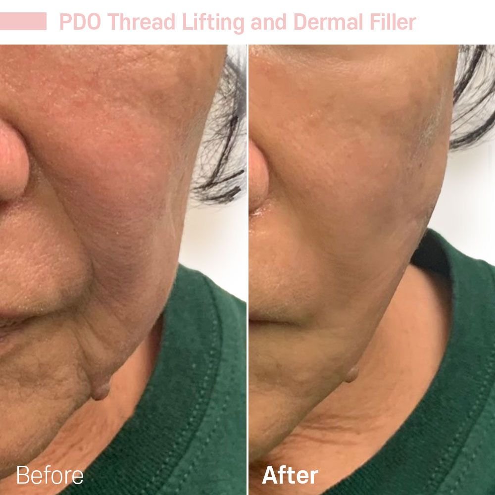 IMG_0627 — before and after at nūri aesthetics