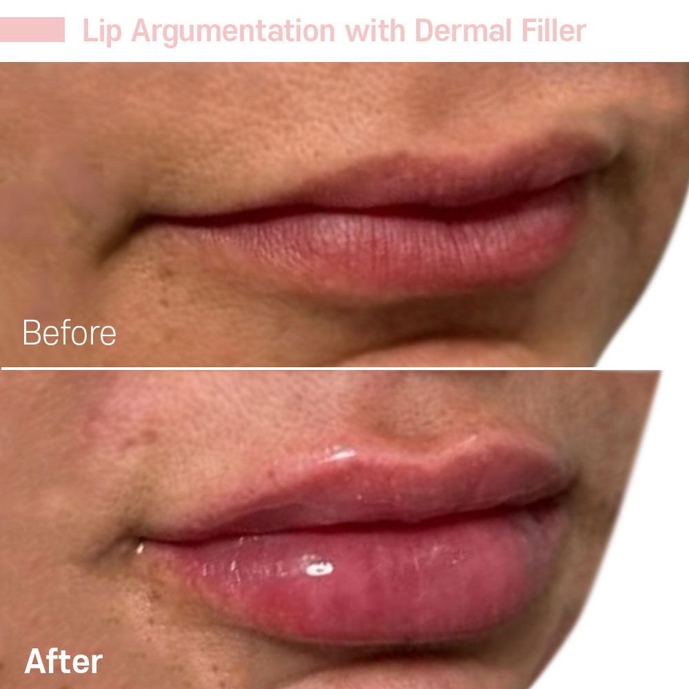 IMG_0639 — before and after at nūri aesthetics