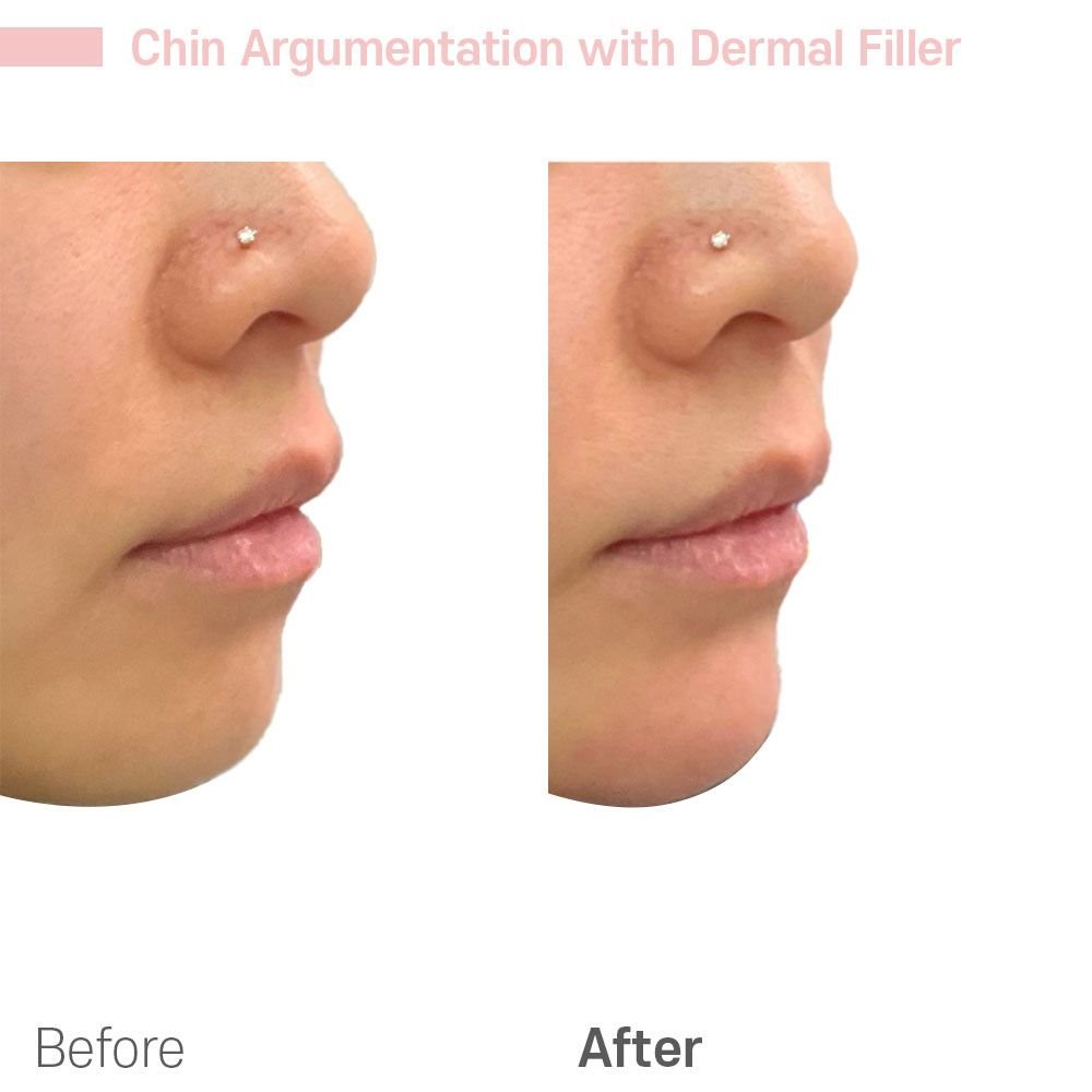 IMG_0653 — before and after at nūri aesthetics
