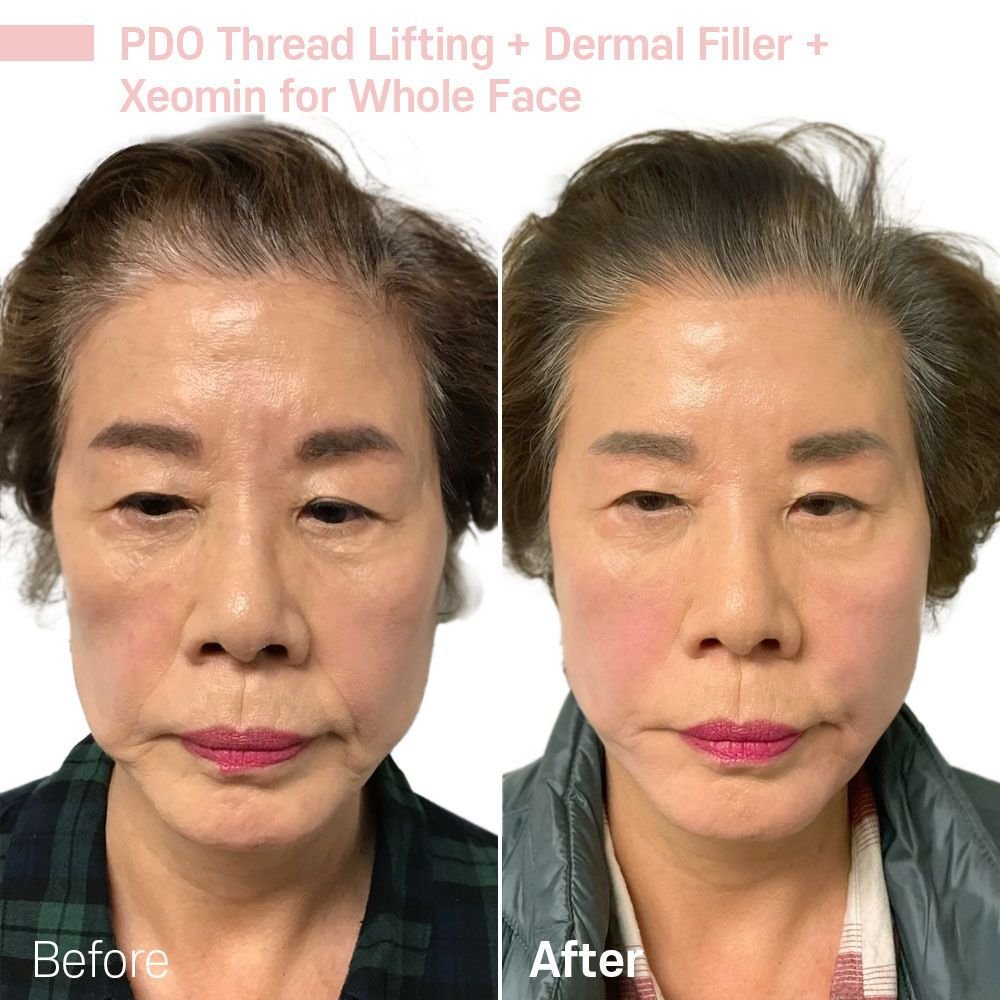 IMG_0655 — before and after at nūri aesthetics