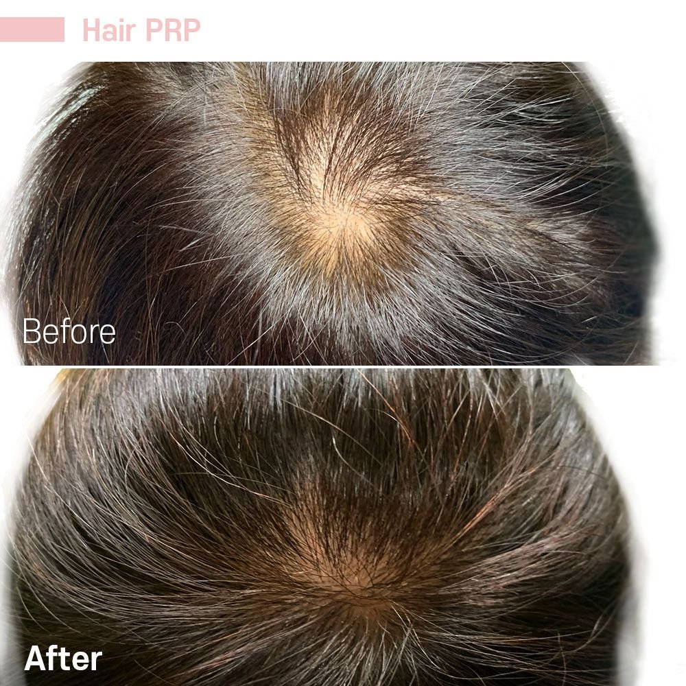 IMG_0762 — before and after at nūri aesthetics