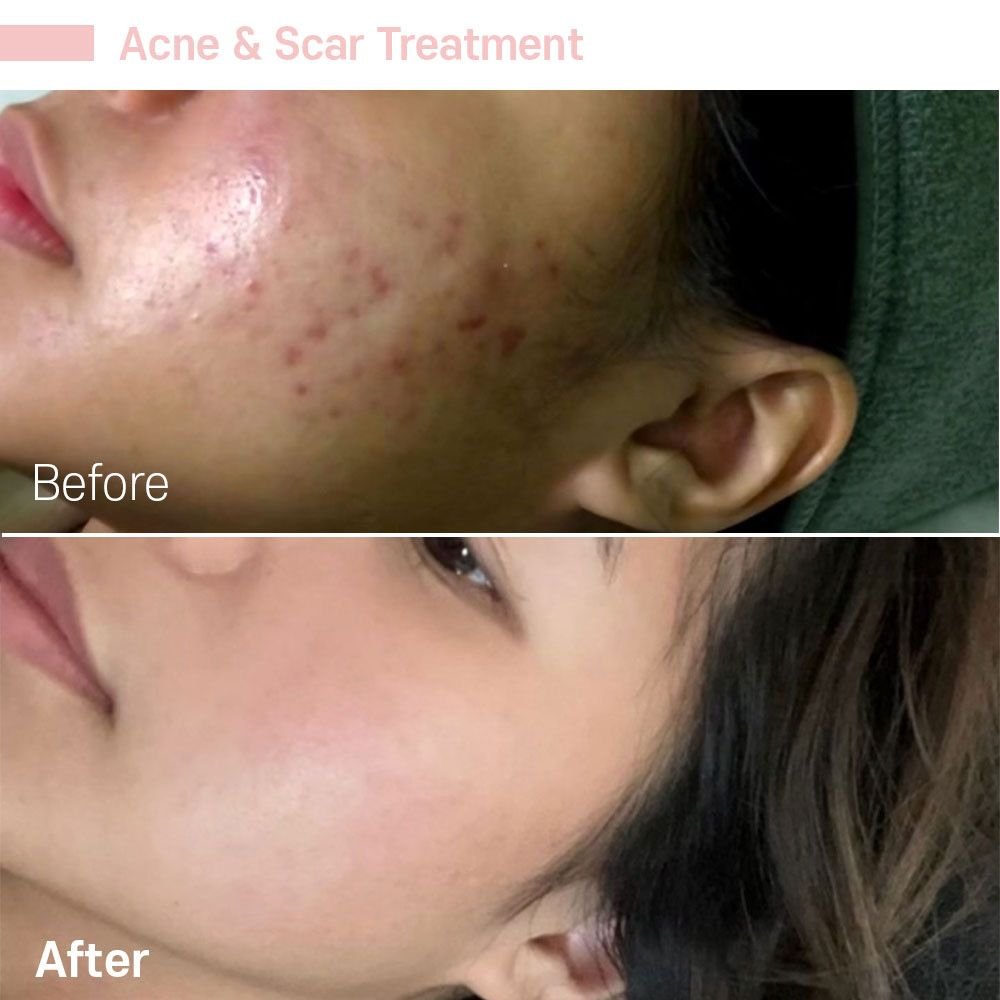 IMG_0763 — before and after at nūri aesthetics