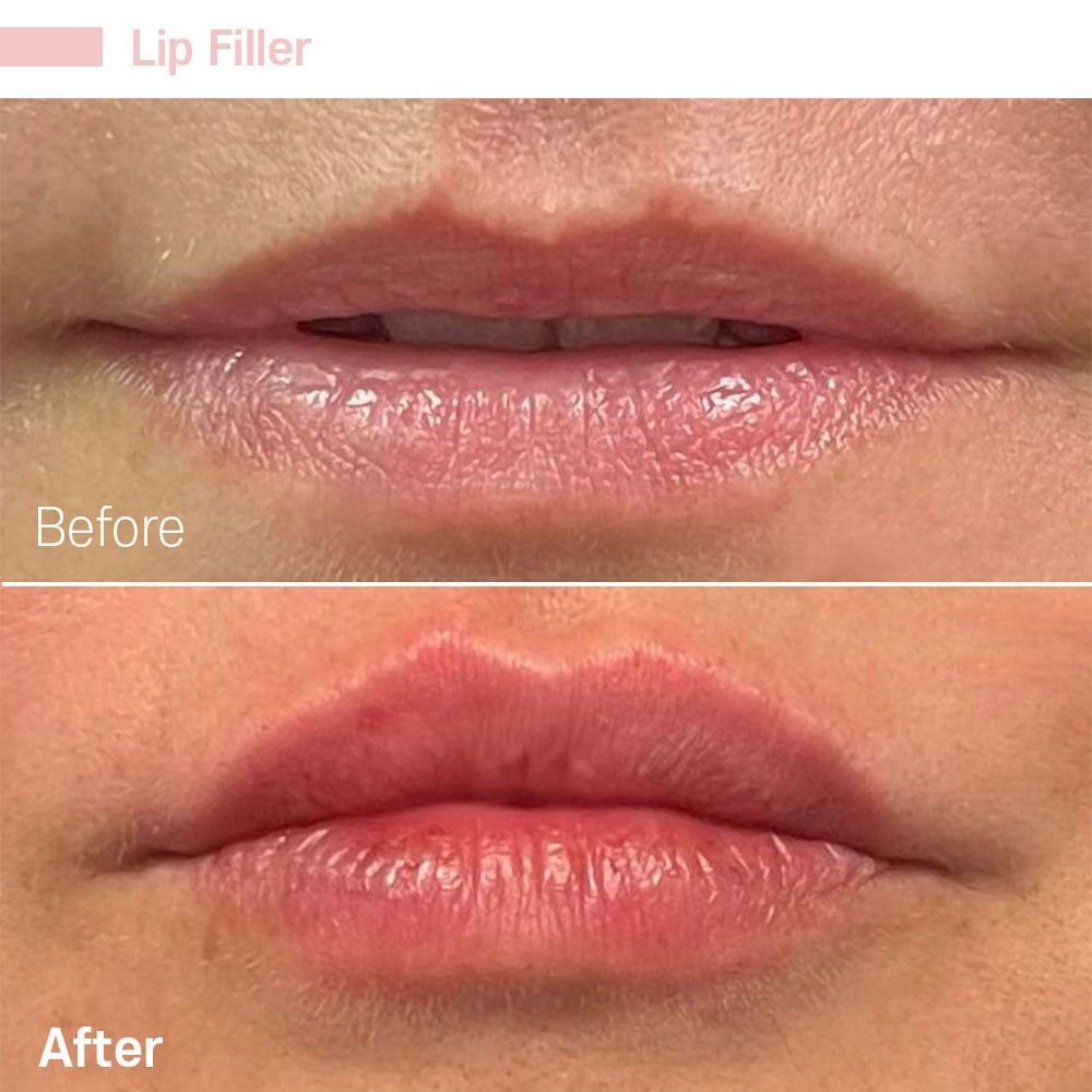 IMG_0764 — before and after at nūri aesthetics