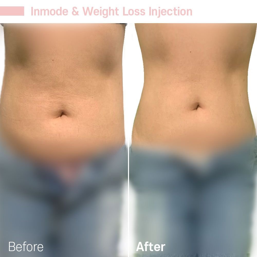 Inmode Weight Loss 2 — before and after at nūri aesthetics