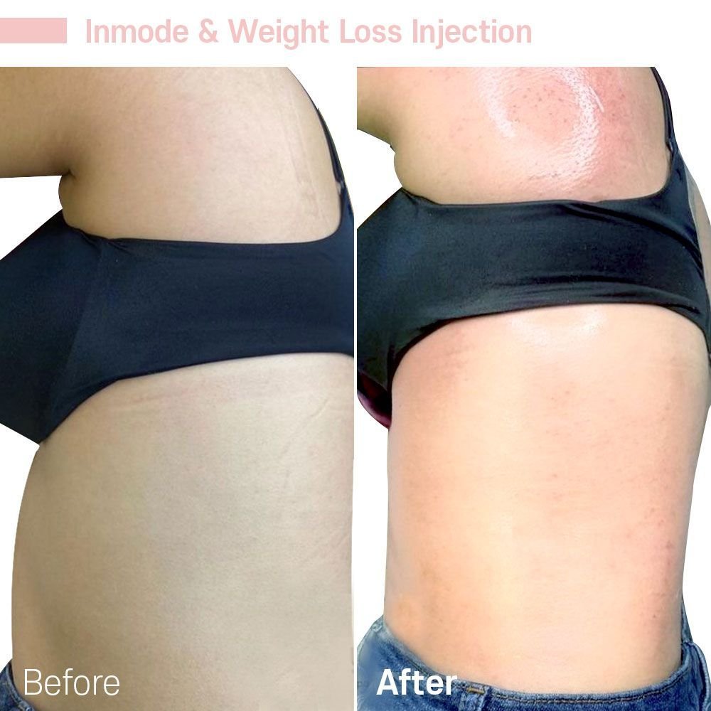 Inmode Weight Loss — before and after at nūri aesthetics