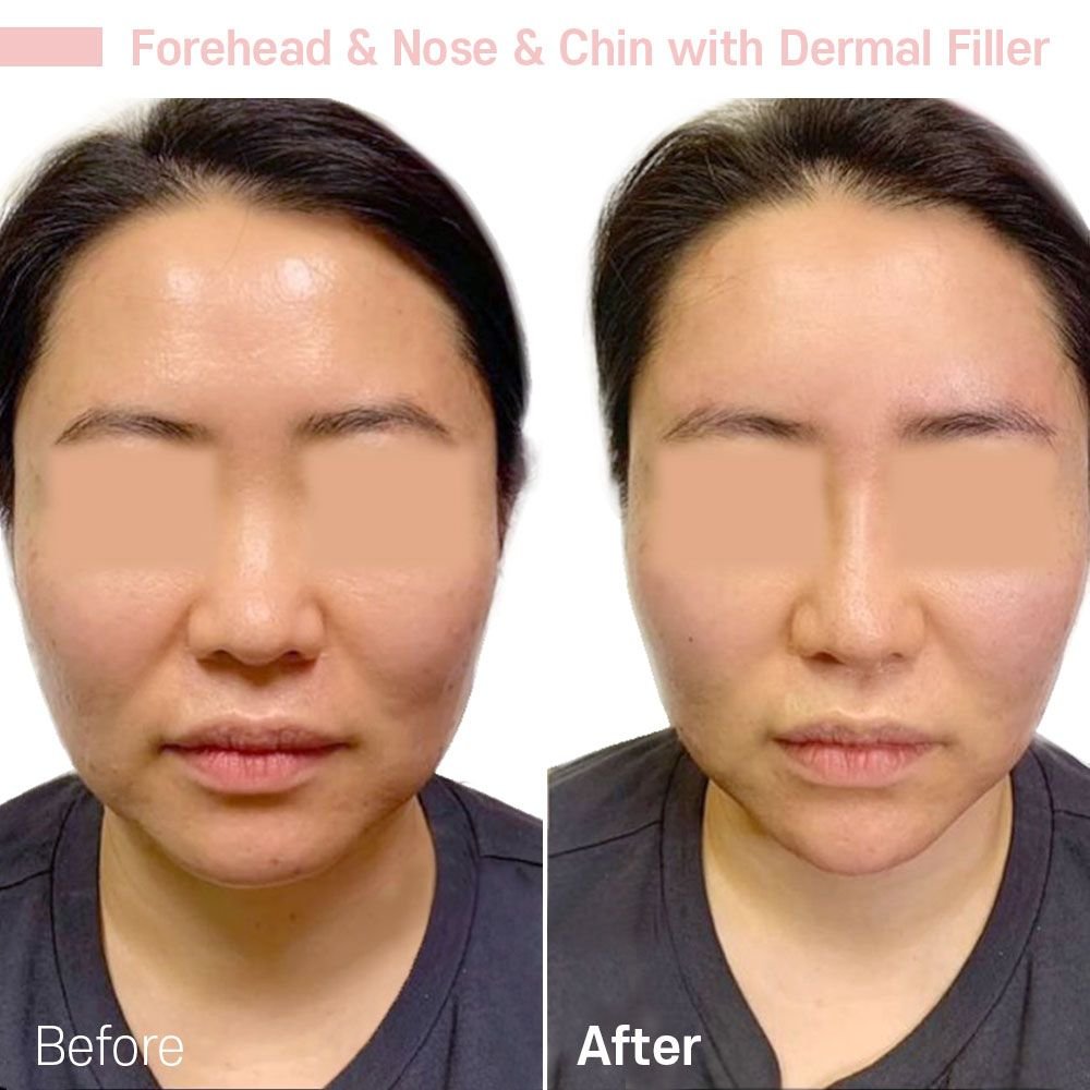 Whole Face — before and after at nūri aesthetics